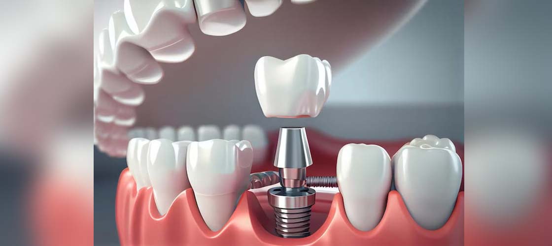 Understanding Dental Implants: The Process and Benefits