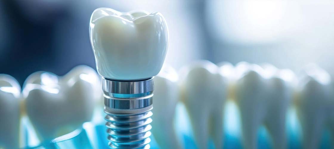 Common Misconceptions About Dental Implants Debunked