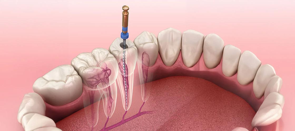 Stress-Free Root Canal Treatments: What You Need to Know