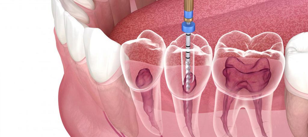 Stress-Free-Root-Canal-003