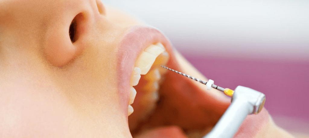 Stress-Free-Root-Canal-004